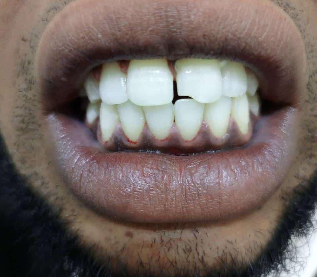 Before teeth whitening