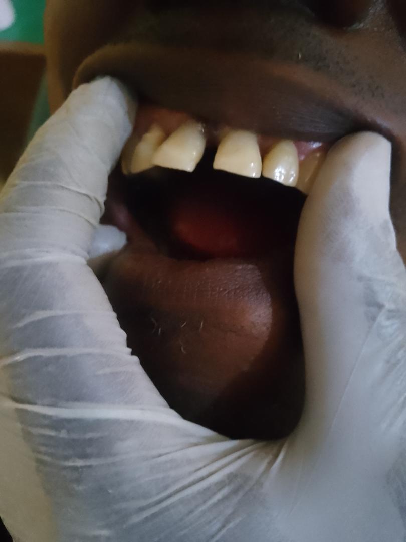 Before composite filling