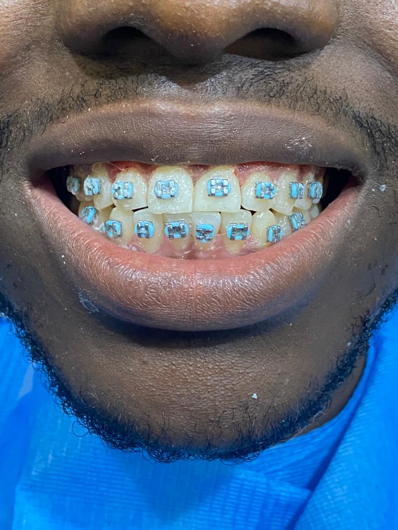 Before teeth bracing