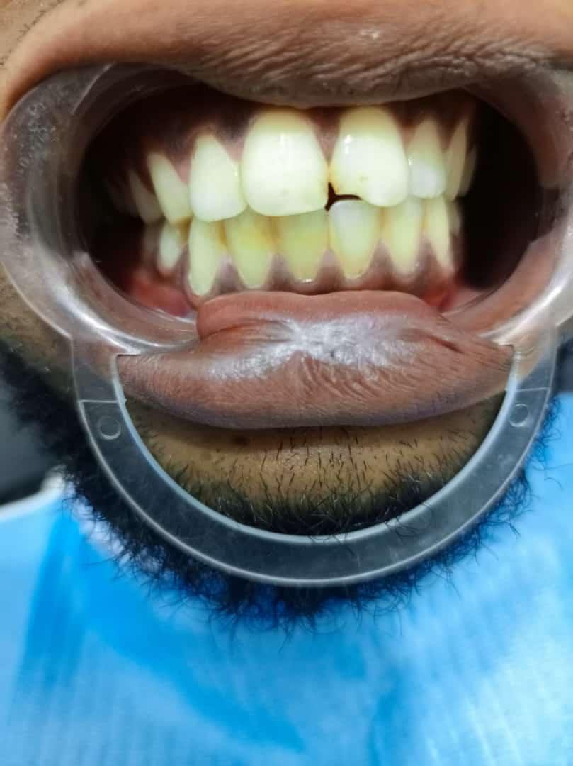After teeth whitening