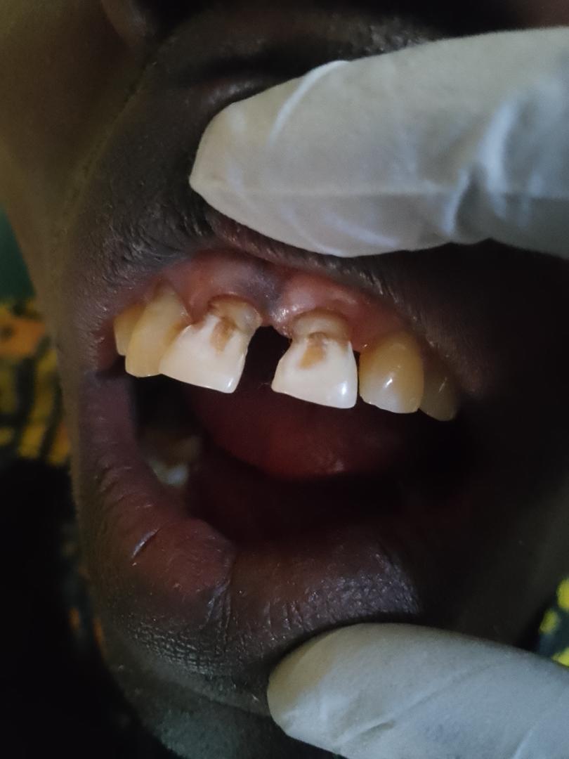 After composite filling