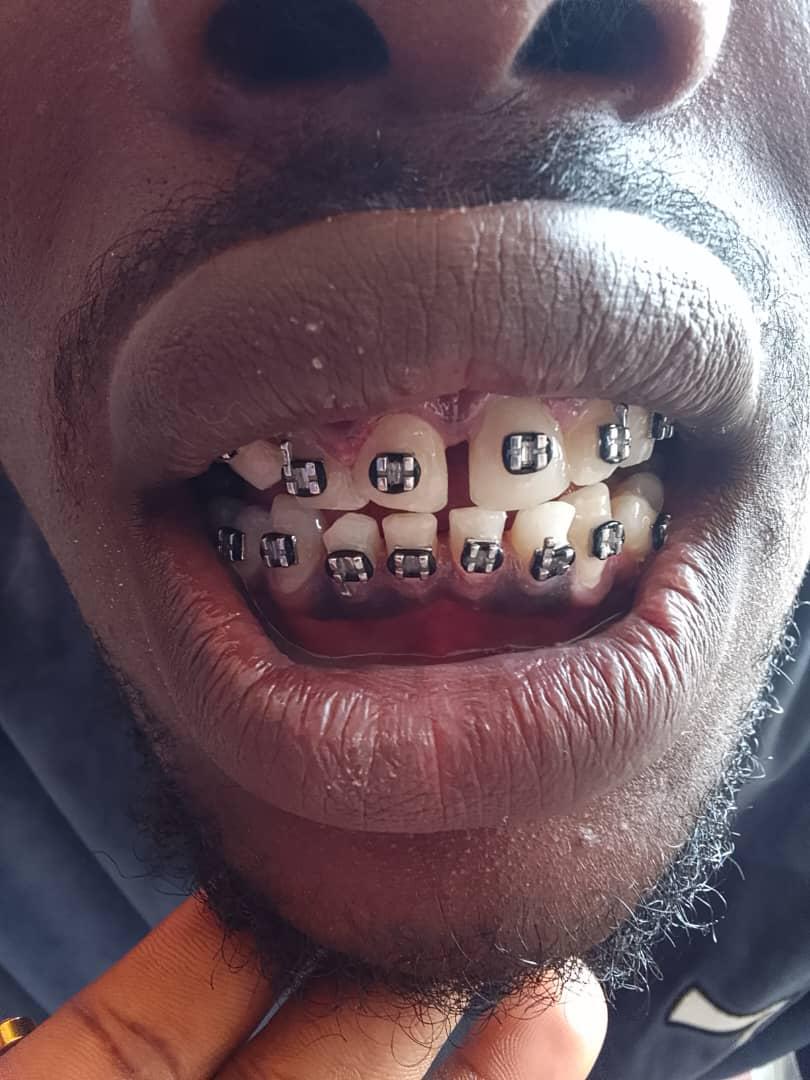 After teeth bracing